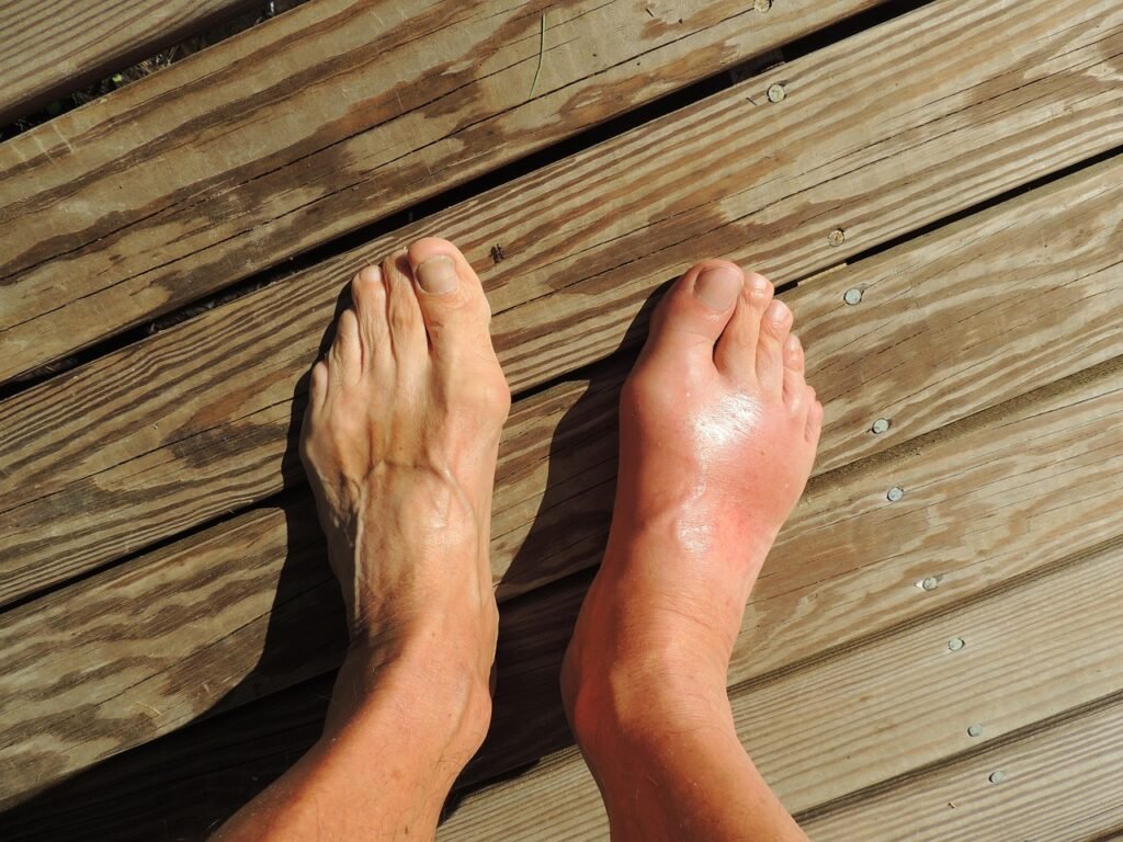 feet, gout, pain, foot, human, anomaly, barefoot, flatfoot, toes, ankle, sole, brown pain, brown human, gout, gout, gout, gout, gout, pain, foot