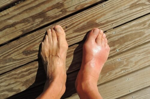 feet, gout, pain, foot, human, anomaly, barefoot, flatfoot, toes, ankle, sole, brown pain, brown human, gout, gout, gout, gout, gout, pain, foot
