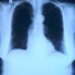 x-ray image, roentgen, thorax, lung x-ray, medicine, roentgen, roentgen, roentgen, roentgen, roentgen